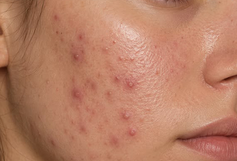Acne Control