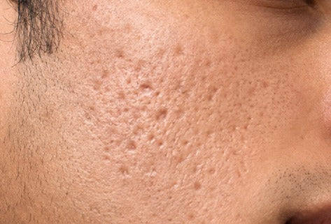 Pitted Acne Scars