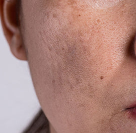Dark Spots